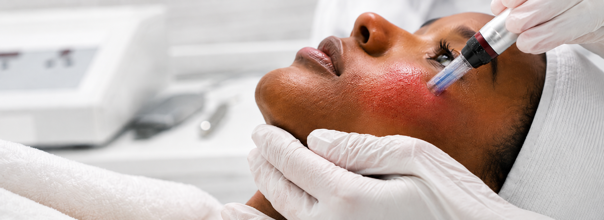 Skin rejuvenation treatment